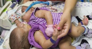Conjoined-Twins-665x385