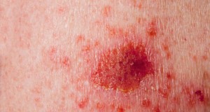 Skin cancer istock