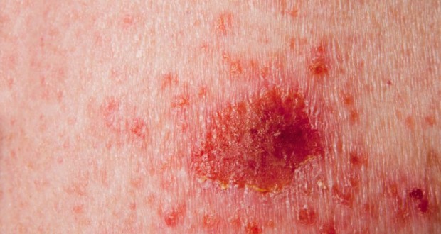 Skin cancer istock