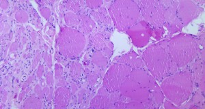 PHIL_2767_Poliovirus_Myotonic_dystrophic_changes