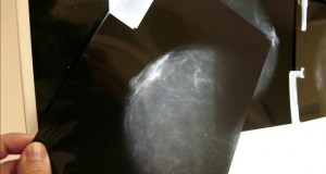 Terapia combinada antes de cirugía reduce riesgo de recaída en cáncer de mama Vista de una prueba radiológica de mama.