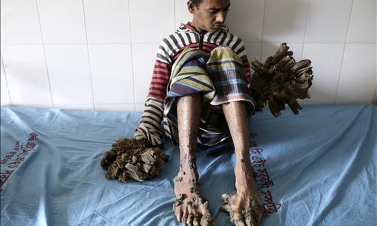 Un hospital de Bangladesh se prepara para operar al "hombre árbol"
Abul Bajandar, un paciente diagnosticado con epidermodisplasia verruciforme, recibe atención médica en Dacca (Bangladesh) hoy, 1 de febrero de 2016. Abul sufre de esta enfermedad desde los 4 años.