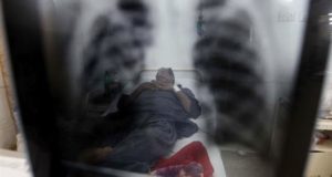 La tuberculosis es una enfermedad causada por la bacteria "Mycobacterium tuberculosis", y está vinculada a factores sociales y económicos. EFE/Archivo