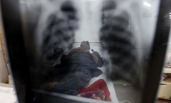 La tuberculosis es una enfermedad causada por la bacteria "Mycobacterium tuberculosis", y está vinculada a factores sociales y económicos. EFE/Archivo